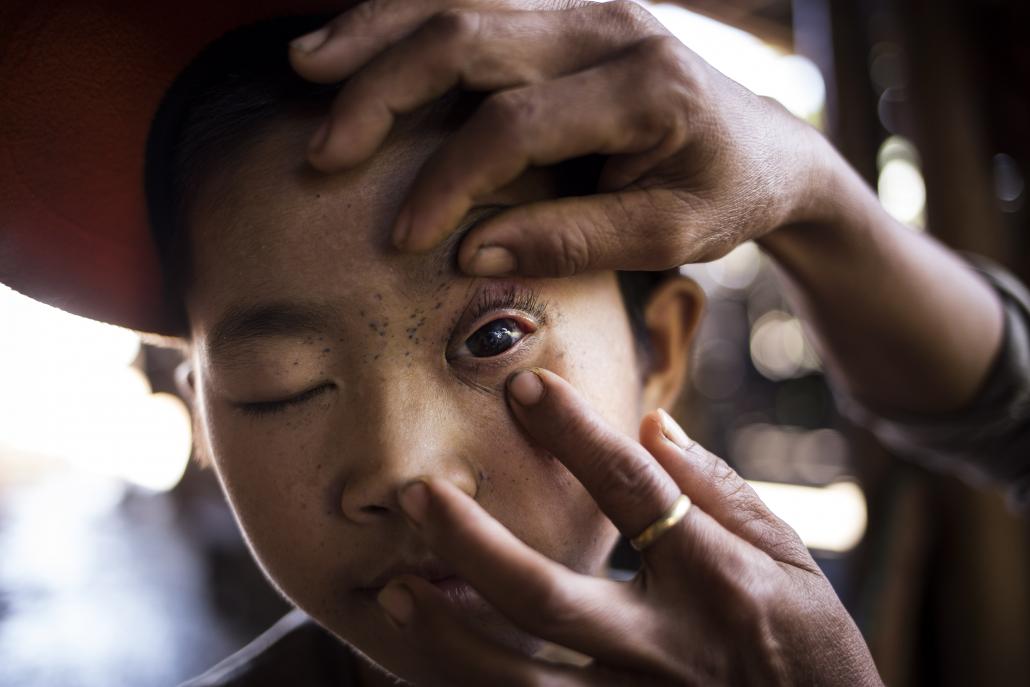 injuries from the incident left marks on Luo Ben Cing’s face and body. (Ann Wang / Frontier)