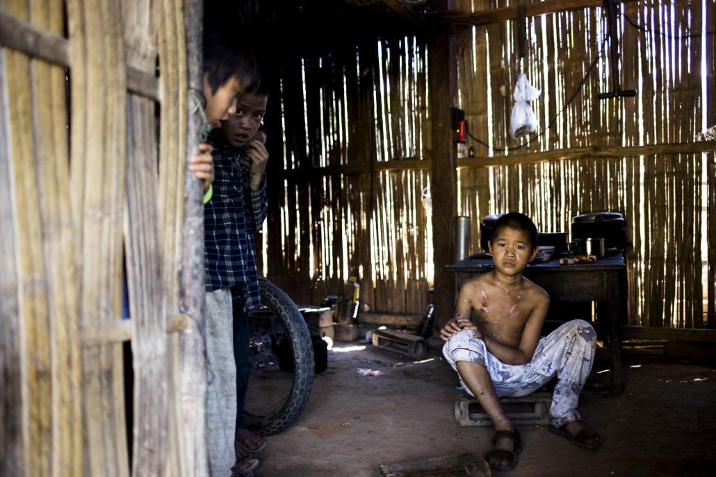 injuries from the incident left marks on Luo Ben Cing’s face and body. The school bag he carried over his belly on the day of his accident may have saved his life. (Ann Wang / Frontier)