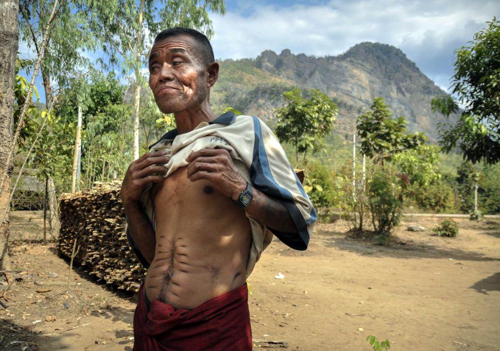 Saw Khay Mee, a DKBA veteran, holds up his shirt to reveal injuries he suffered while fighting for the KNU in the early 1990s. He is now head of a village for DKBA veterans and their families. (Kyaw Lin Htoon | Frontier)