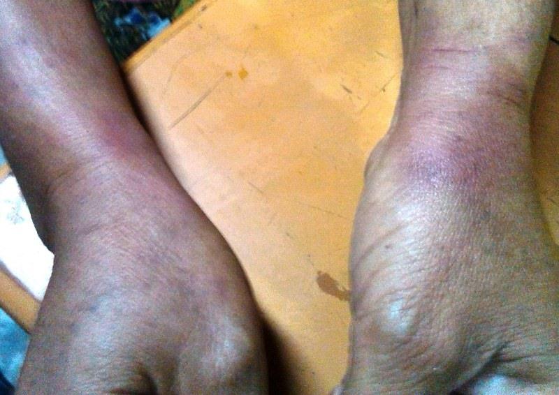 Photos shared on Facebook showing bruising on the arms of a student who was wrongfully detained by Mandalay police. (Supplied)