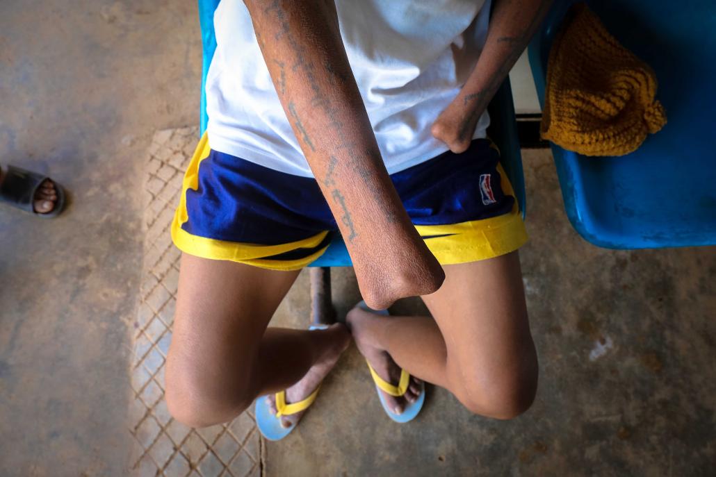 Sai Leng, 48, sits in front of the Loi Kaw Wan medical facility. He lost his hands in a land mine blast while fleeing Myanmar. (Victoria Milko | Frontier)